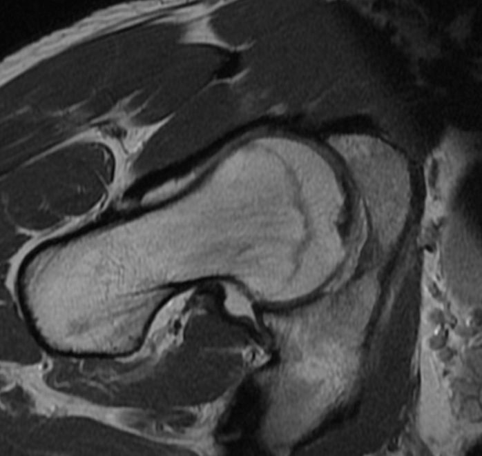 Figure 3 for case Osteoid osteoma ( RID4005 )